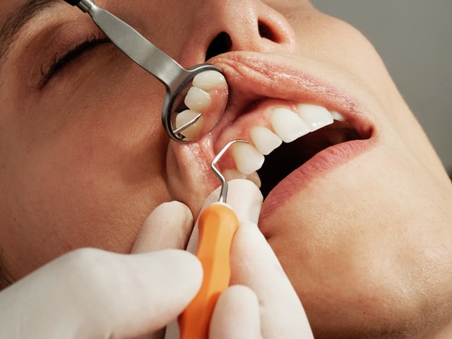 Periodontal Maintenance