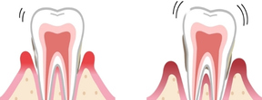 Early to late gum disease without periodontal maintenance