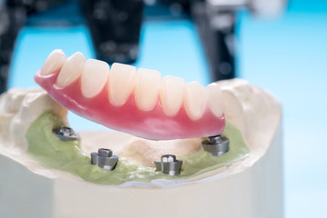 Implant Retained Dentures Teeth