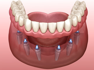 norwalk ca implant retained denture