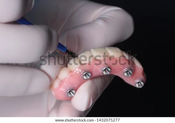 A dental technician holding an implant retained denture