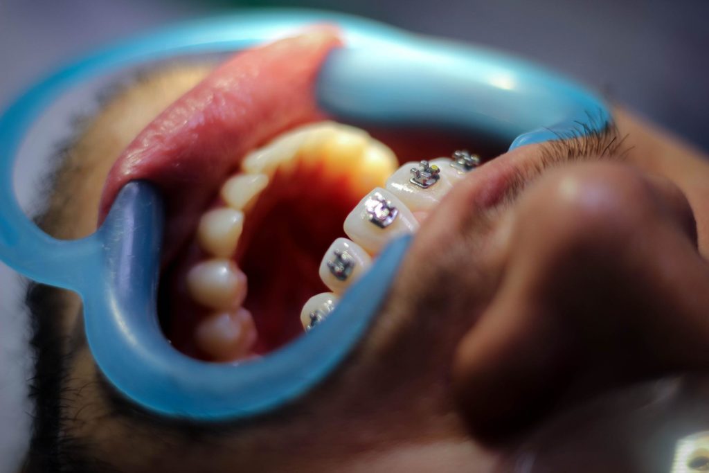 dental patient with braces on