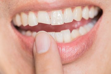 woman-chipped-tooth-dental-crowns