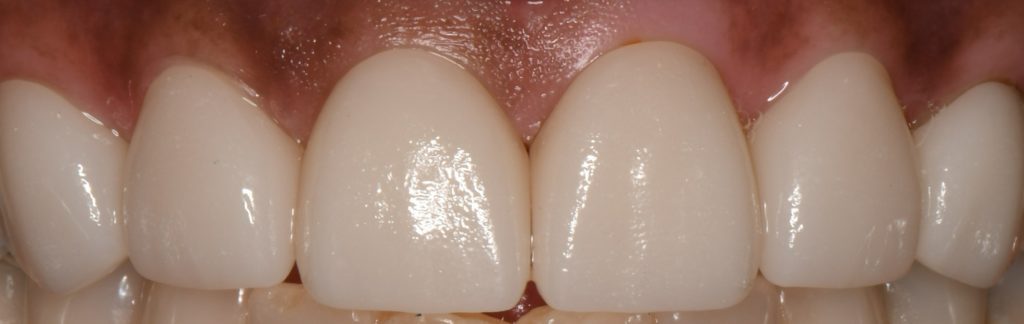 Cosmetic placement of veneers