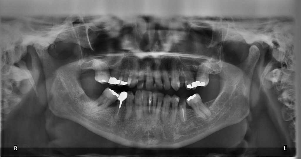 black-and-white patient panoramic x-rays