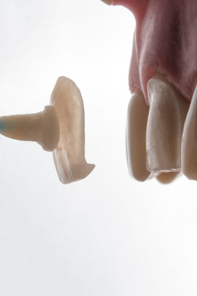 a veneer being applied to a prepared tooth