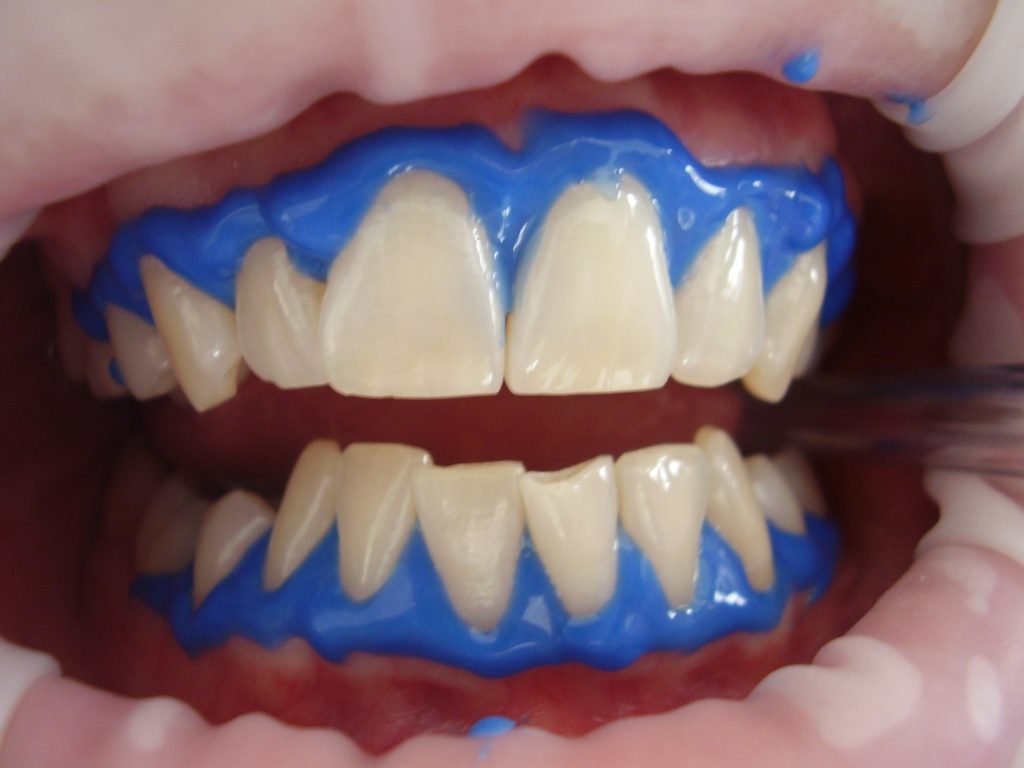 A close-up shot of teeth with blue material on the gums